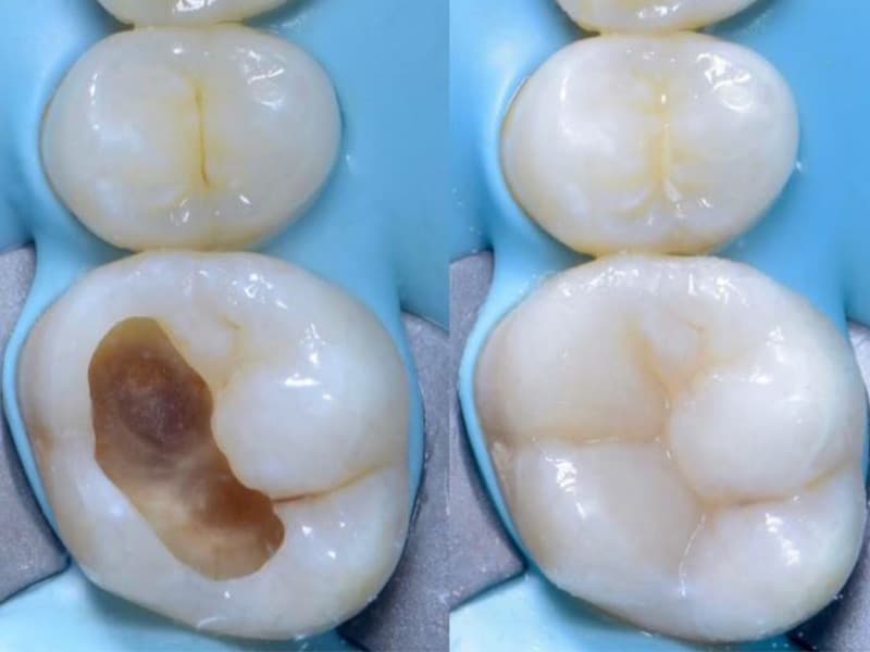 composite filling