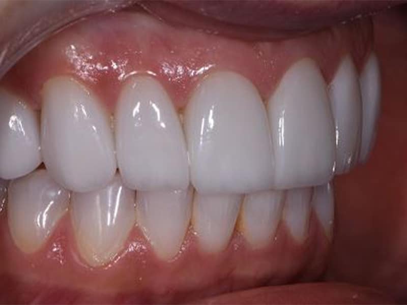porcelain veneers