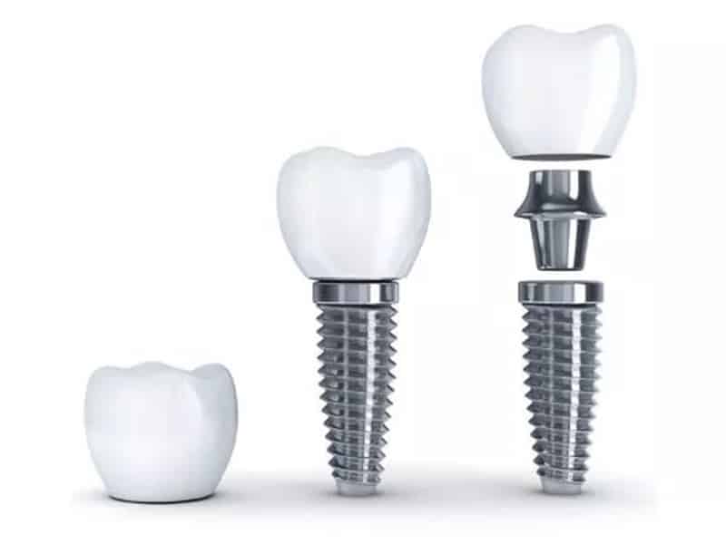 dental implants